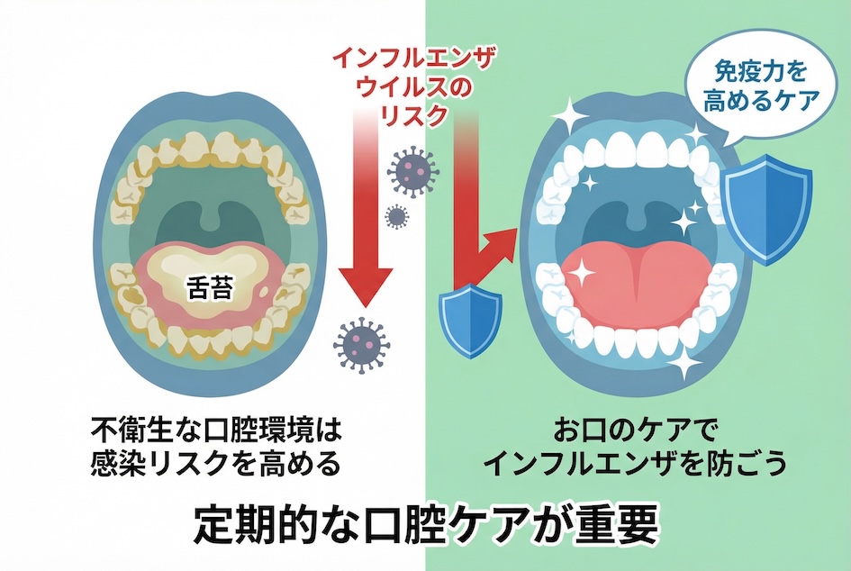 インフルエンザは口から始まる ウイルスを招き入れる口腔環境とは