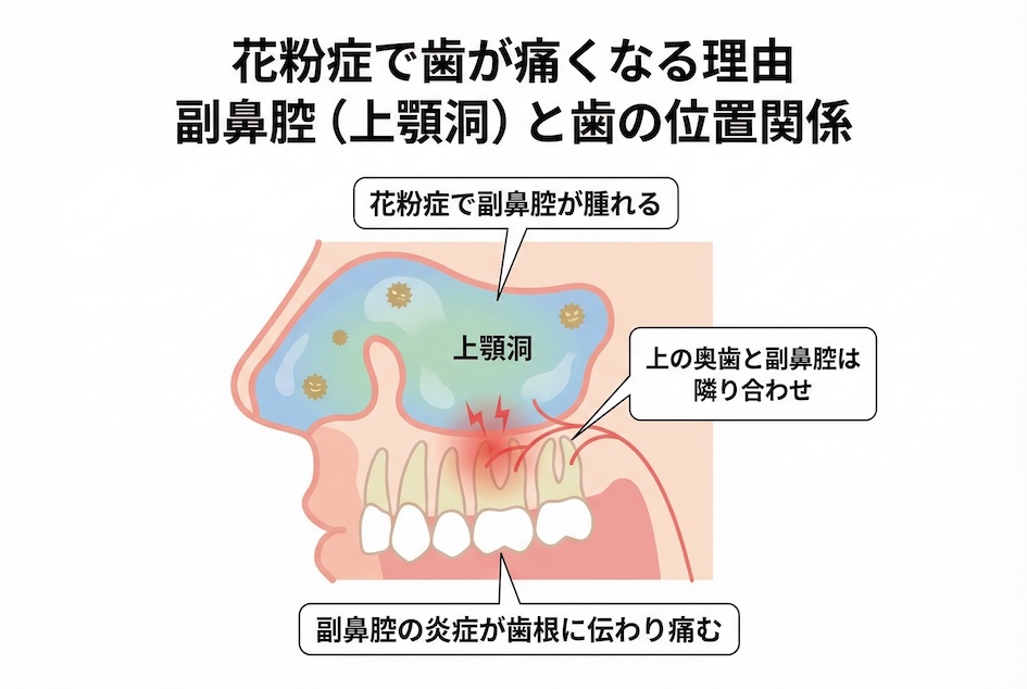 花粉症で歯が痛くなる理由 副鼻腔（上顎洞）と歯の位置関係