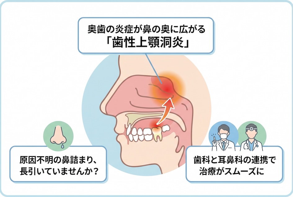 鼻詰まりの原因は歯だった?奥歯の炎症が引き起こす「歯性上顎洞炎」の話