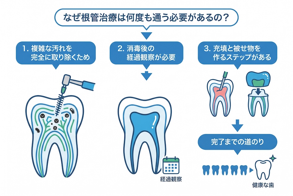 なぜ根管治療は何度も通う必要があるの？