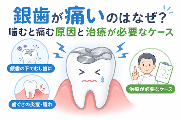 銀歯が痛いのはなぜ?噛むと痛む原因と治療が必要なケース