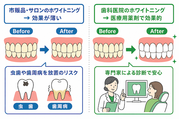 安易なセルフホワイトニングは危険?歯科医院で行うべき本当の理由